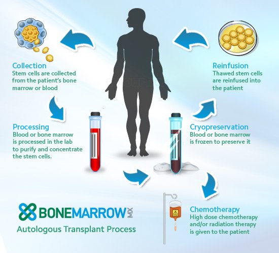 bone marrow transplant procedure
